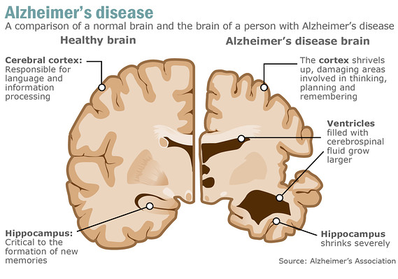 Landmark Moment in Treatment of Alzheimer's All Set to Be Unveiled | Northern