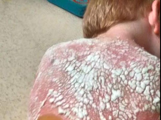 Mother Says 2 Oklahoma Boys Severely Sunburned On Daycare Trip | News OK