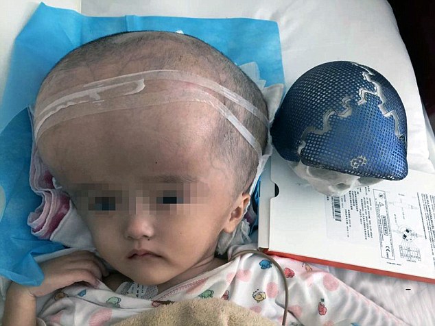 Unwell Chinese baby Han Han 3 had a condition which made her head grow to four times the normal size