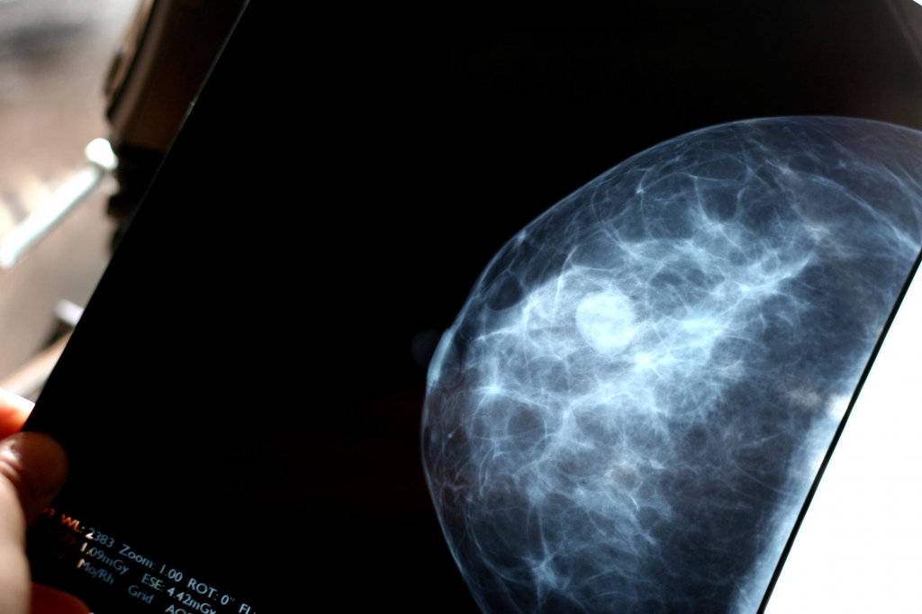 Breast cancer screening 'overrated'