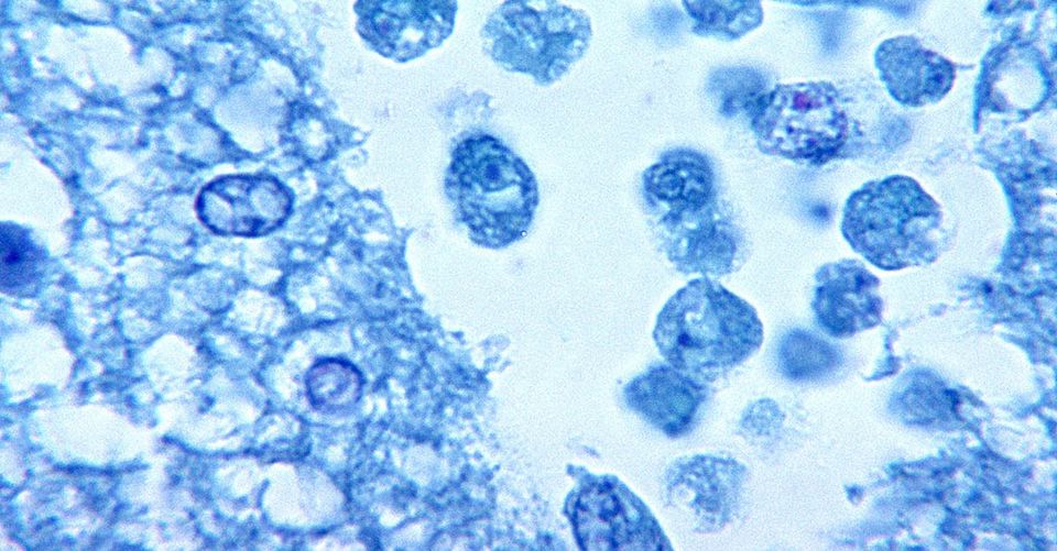 Naegleria Fowleri Amoeba Cases: Man Dies After Swimming in Lake Murray