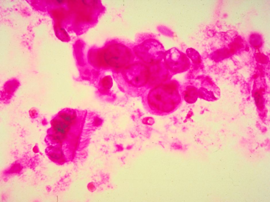 Detail of breast cancer cells. Breast cancer is a malignant growth that begins in the tissues of the breast