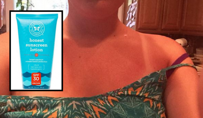 Honest Company Sunburn