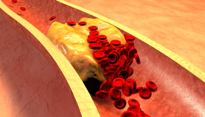 Testosterone supplements don't contribute to clogged arteries