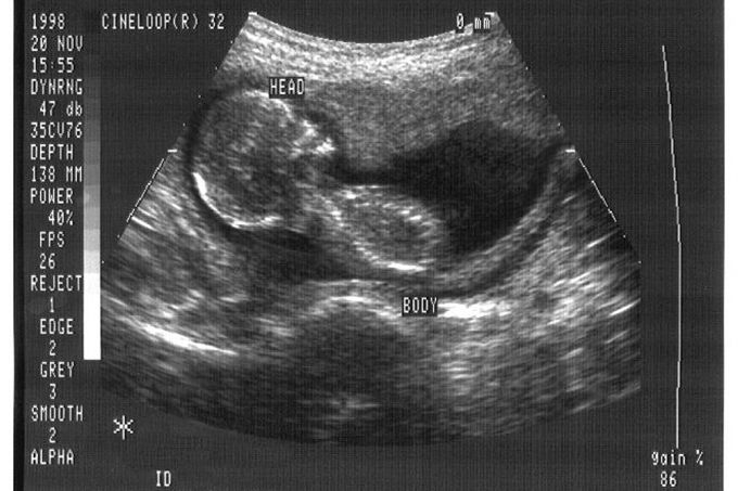 Ultrasound. Credit CDC  Jim Gathany. Public domain