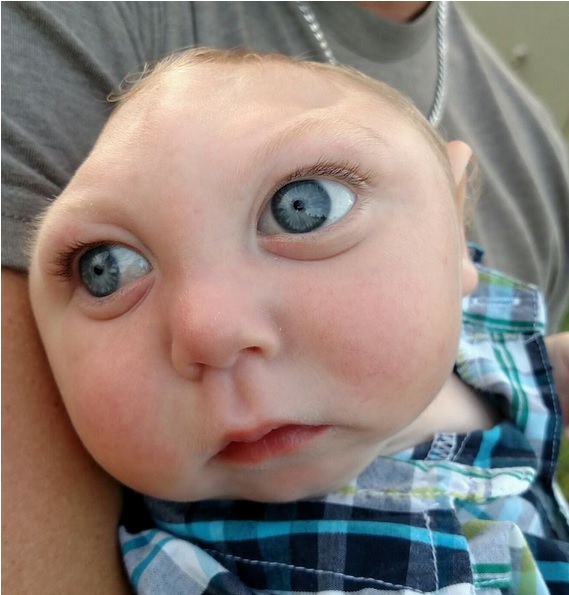 Jaxon Strong: Baby with Microhydranencephaly is an inspiration