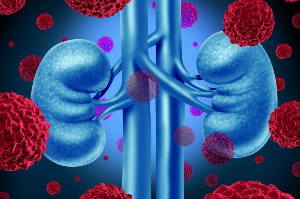 METEOR: Cabozantinib Improves Survival in Advanced Kidney Cancer