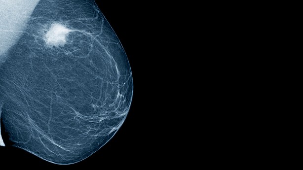 Breast density and cancer risk: What is the relationship?