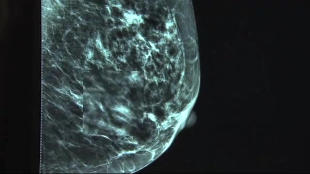 New study shows less toxic breast cancer treatments may be possible story image