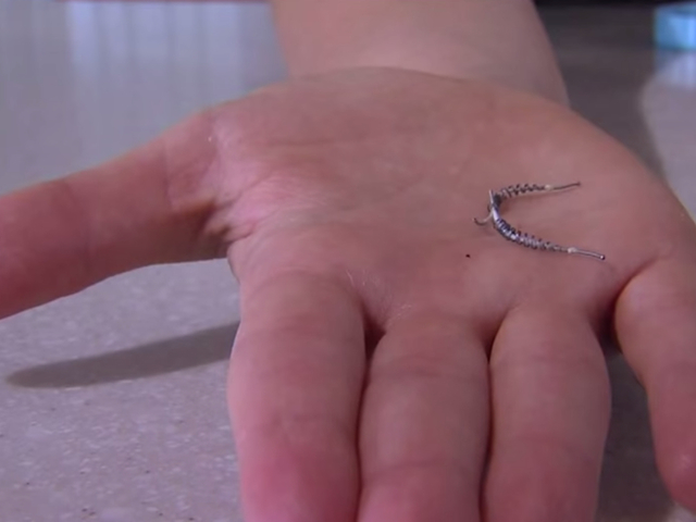 The Essure birth control implant is seen in this video screenshot image