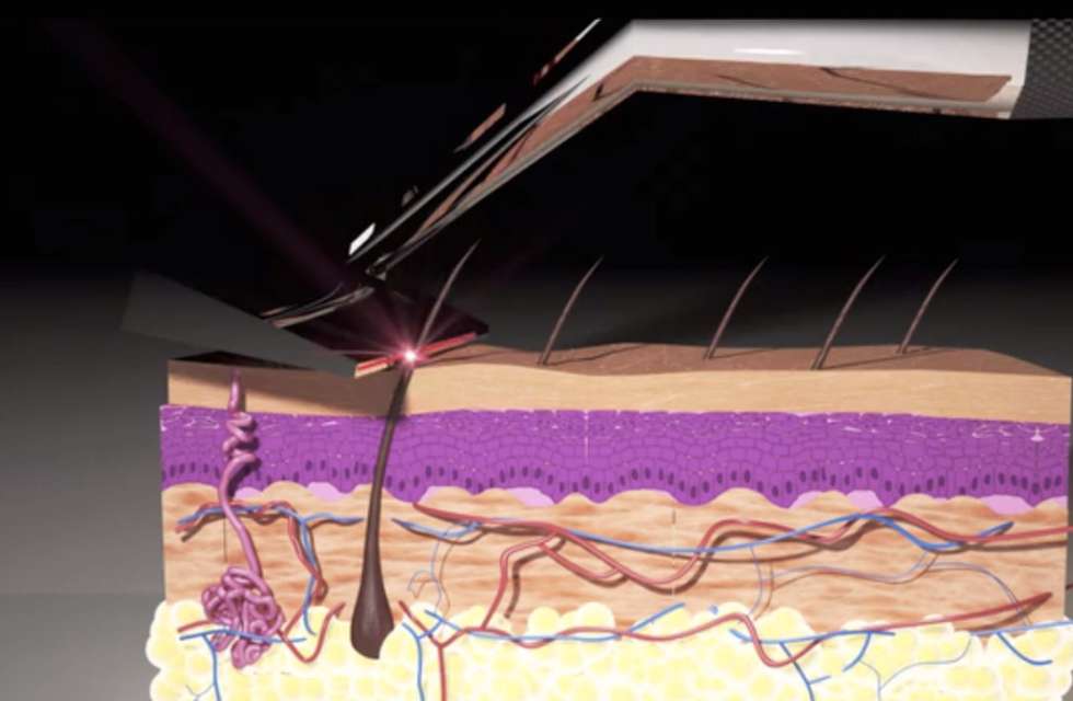 Animation showing how the Skarp Laser Razor works