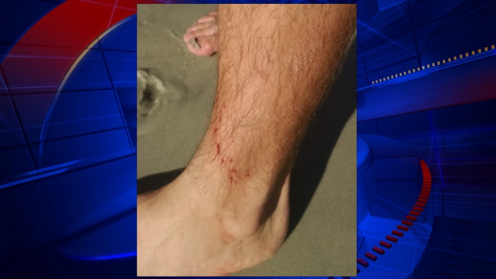 Shark bites New Smyrna Beach surfer