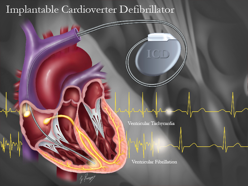 A diagram of an ICD implanted in the chest or abdomen of a heart patient