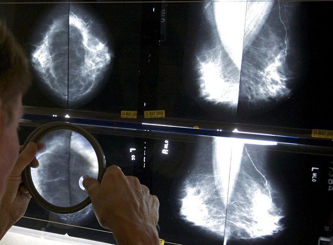 A radiologist uses a magnifying glass to check mammograms for breast cancer in Los Angeles