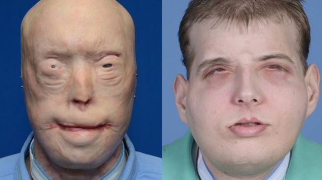 Transplant gives new face, scalp to burned volunteer firefighter, will restore