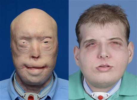 Disfigured Firefighter Receives Most Extensive Face Transplant to Date at NYU