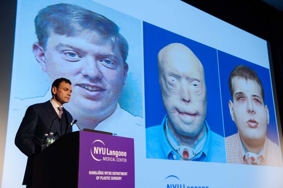 Dr. Eduardo Rodriguez talks about the successful completion of the most extensive face transplant to date at New York University’s Langone Medical Center in New York. The procedure in August transferred the face of David Rodebaugh to Patrick Hardison. P