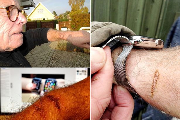 Apple Watch 'burns owner' so badly that he could smell his sizzling skin