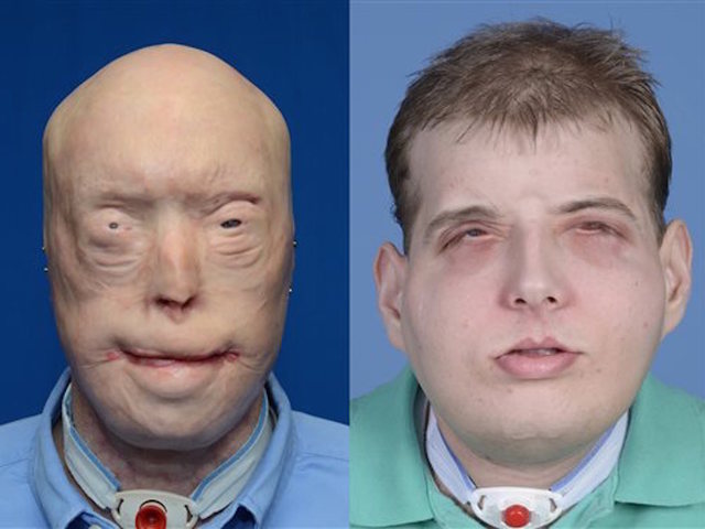 Disfigured Firefighter Receives Most Extensive Face Transplant to Date at NYU