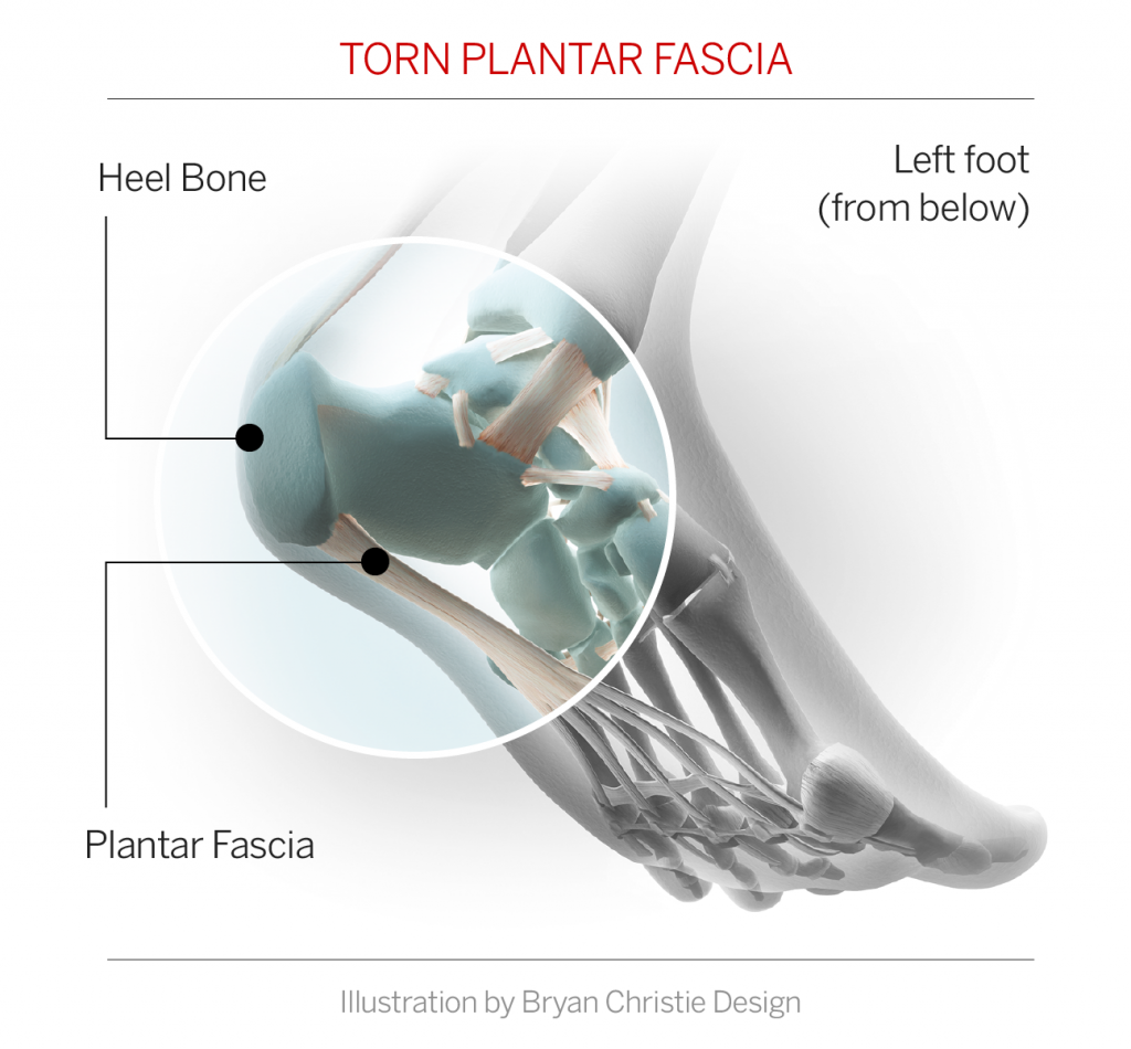 Peyton Manning Injury Update: Foot Has Partially Torn Plantar Fascia