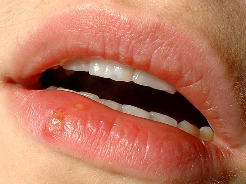 Two thirds of the people in the world carry the virus that causes cold sores