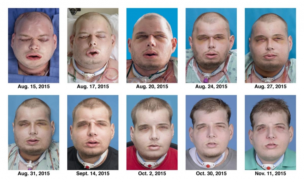 Mississippi Firefighter Receives Most Extensive Face Transplant