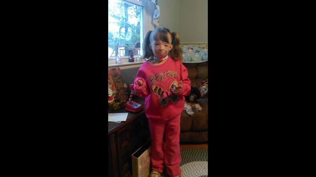 Girl with severe burns only wants cards for Christmas