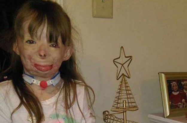 Girl with severe burns only wants cards for Christmas