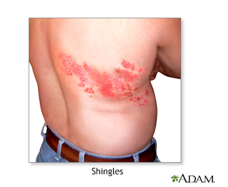 Shingles