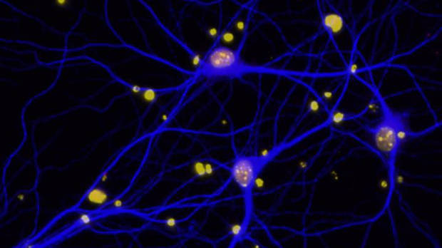 This image shows reduced levels of BRCA1 in neurons. ELSA SUBERBIELLE