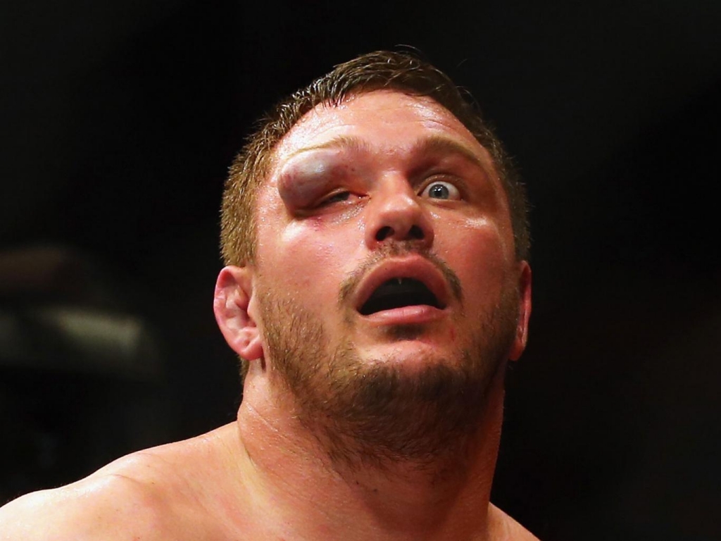 Matt Mitrione suffered a horrific eye injury in his defeat by Travis Browne Getty Images