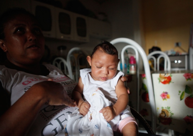 A Brazilian baby suffering from microcephaly which has been linked to the mosquito-borne Zika virus