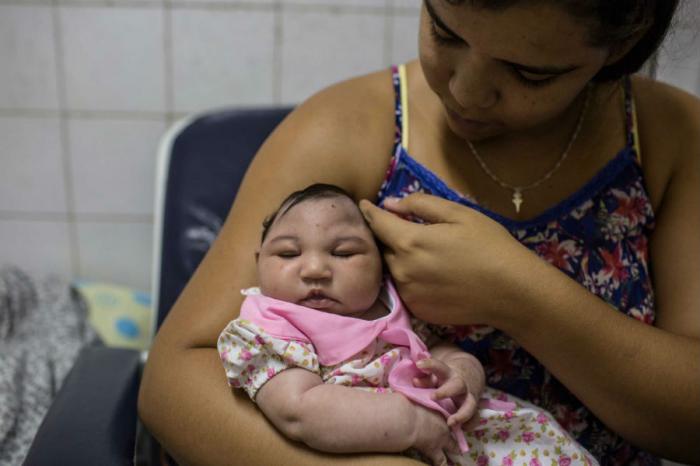 Babies born to Zika-infected women suffer brain damage as a result of smaller-than-average skulls