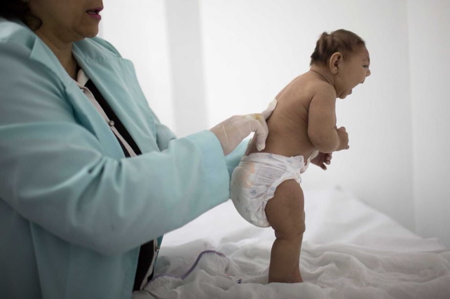 Lara who is less then 3-months old and was born with microcephaly is examined by a neurologist at the Pedro I hospital in Campina Grande Paraiba state Brazil. Scientists suspect an outbreak of the Zika