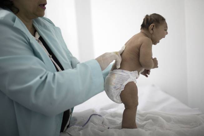 Brazil reports more cases of microcephaly under investigation