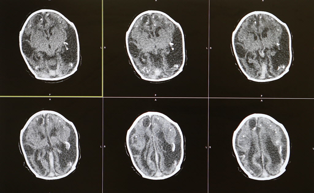 Brain scans of a 2-month-old baby with microcephaly are displayed by Dr. Vanessa Van Der Linden the neuro-pediatrician who first recognized and alerted authorities of the microcephaly crisis in Brazil on Jan. 27 in Recife Brazil. The baby's mother was