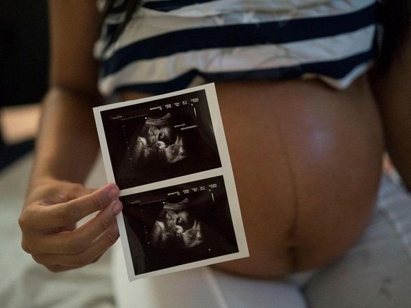 Zika virus 6-month-old pregnant Woman shows