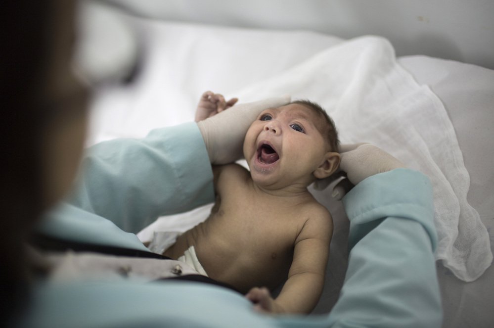 A baby who was born with microcephaly – a birth defect that produces an abnormally small head and an underdeveloped brain – is examined at a hospital in Brazil