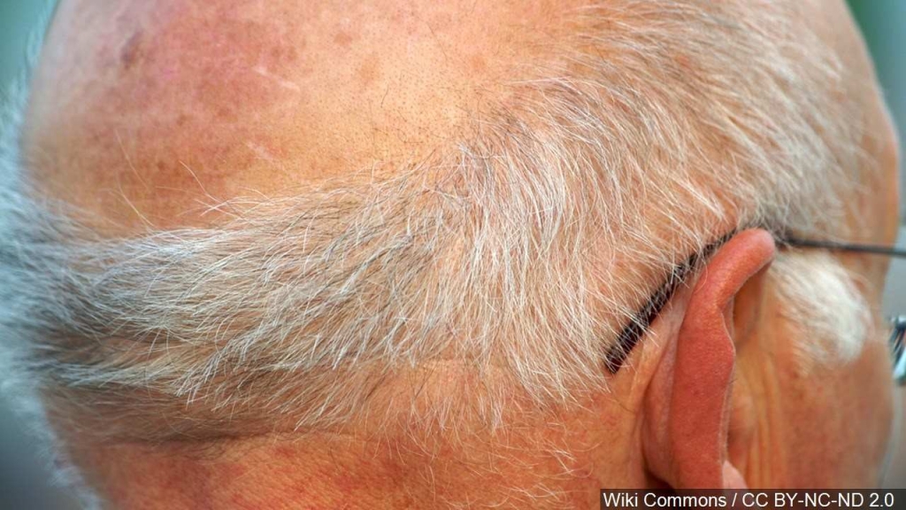 Scientists report finding 'gray hair' gene