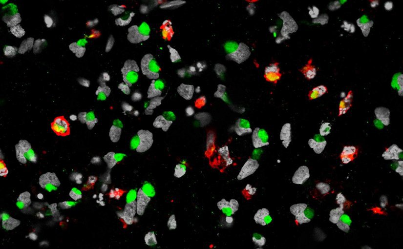 This image shows cell death of the human neural progenitor cells is mark by cleaved caspase 3 in red the nuclei of hNPCs are labeled by DAPI in white  grey and the ZIKA virus is labeled by ZIKA virus envelope protein in green. Credit Sarah C. Ogd