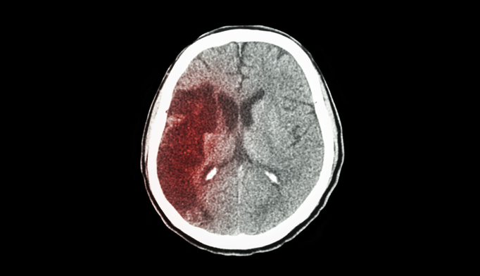 Women were more susceptible to ischemic stroke in the first 2 days following a daylight savings time transition