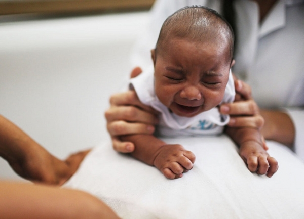 Baby with microcephaly