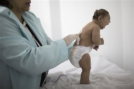 Lara who is less then 3-months old and was born with microcephaly is examined by a neurologist at the Pedro I hospital in Campina Grande Paraiba state Brazil. On Wednesday