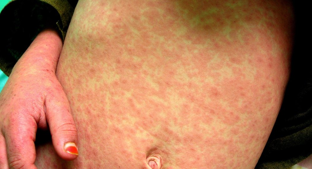 Health officials across the country have been concerned about the spread of measles as dozens were diagnosed with the disease due to anti-vaccination movements