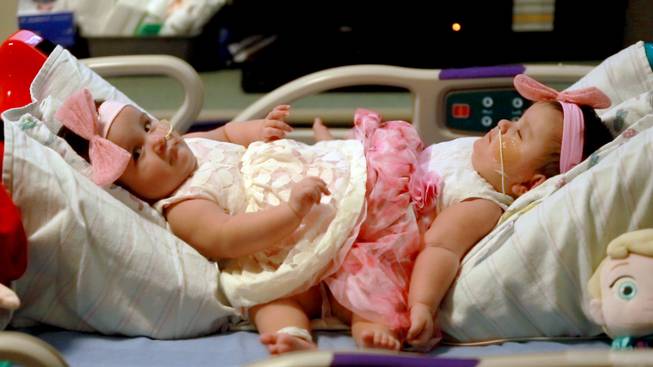 Doctors Use 3D Models of Conjoined Twins to Prepare for Complex Separation Surgery