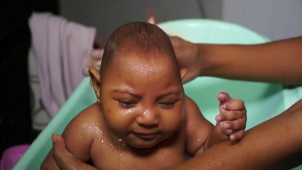 A baby with microcephaly due to Zika virus