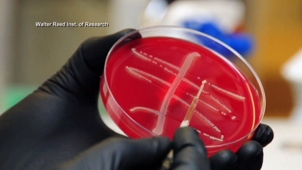 Local medical expert says new'superbug bacteria is resistant to antibiotics