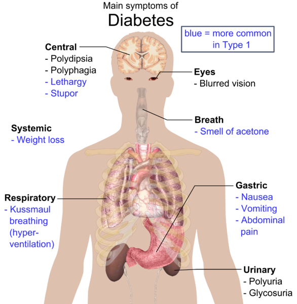 Diabetes symptoms Public domain image  Mikael Häggström