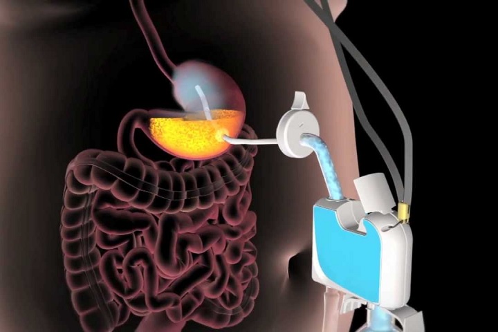 FDA approves novel stomach-emptying device to treat obesity