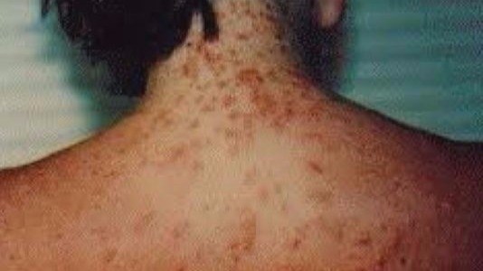 Sea lice invading Gulf Coast beaches, AL.com says